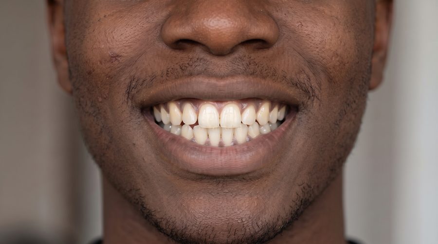 Patient A, front-facing smile, after treatment