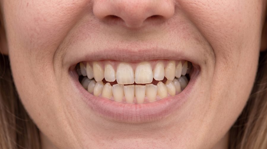 Patient B, front-facing smile, after treatment