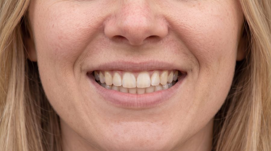 Patient B, front-facing smile, before treatment