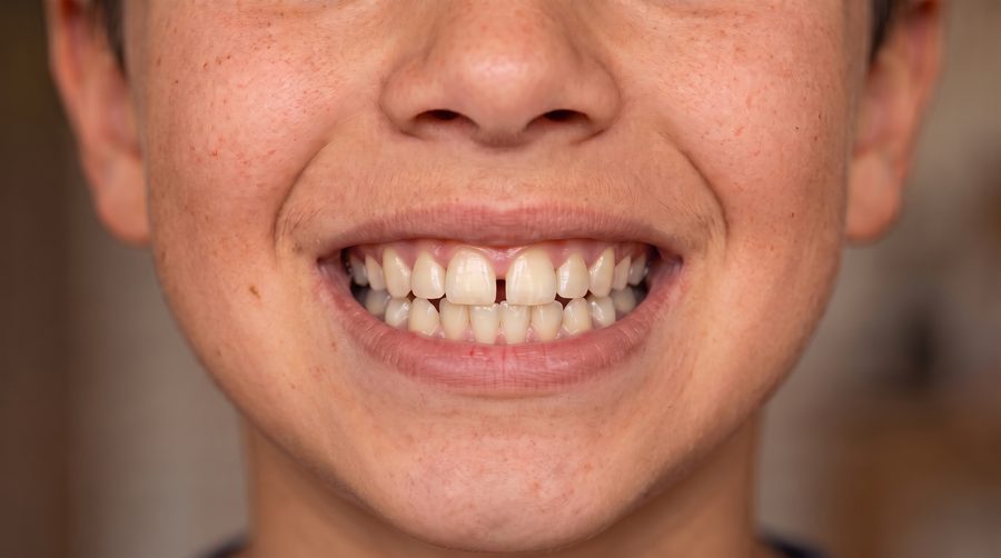 Patient C, front-facing smile, after treatment