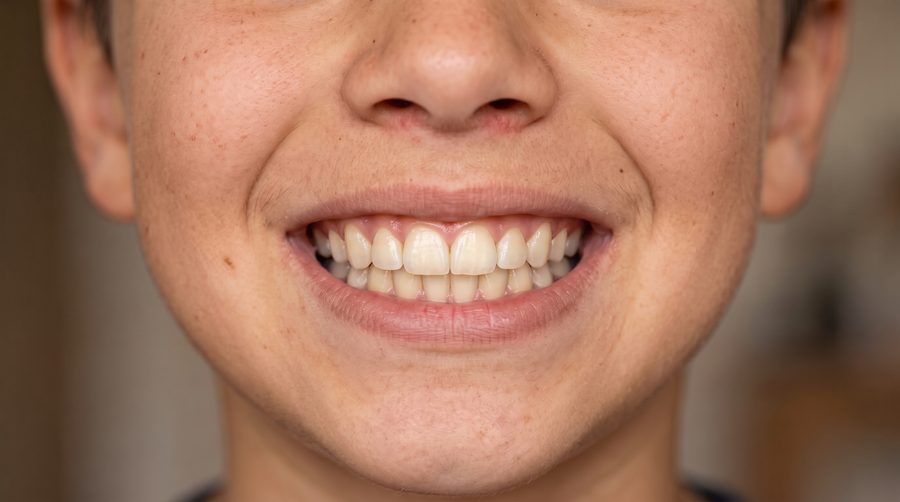 Patient C, front-facing smile, before treatment